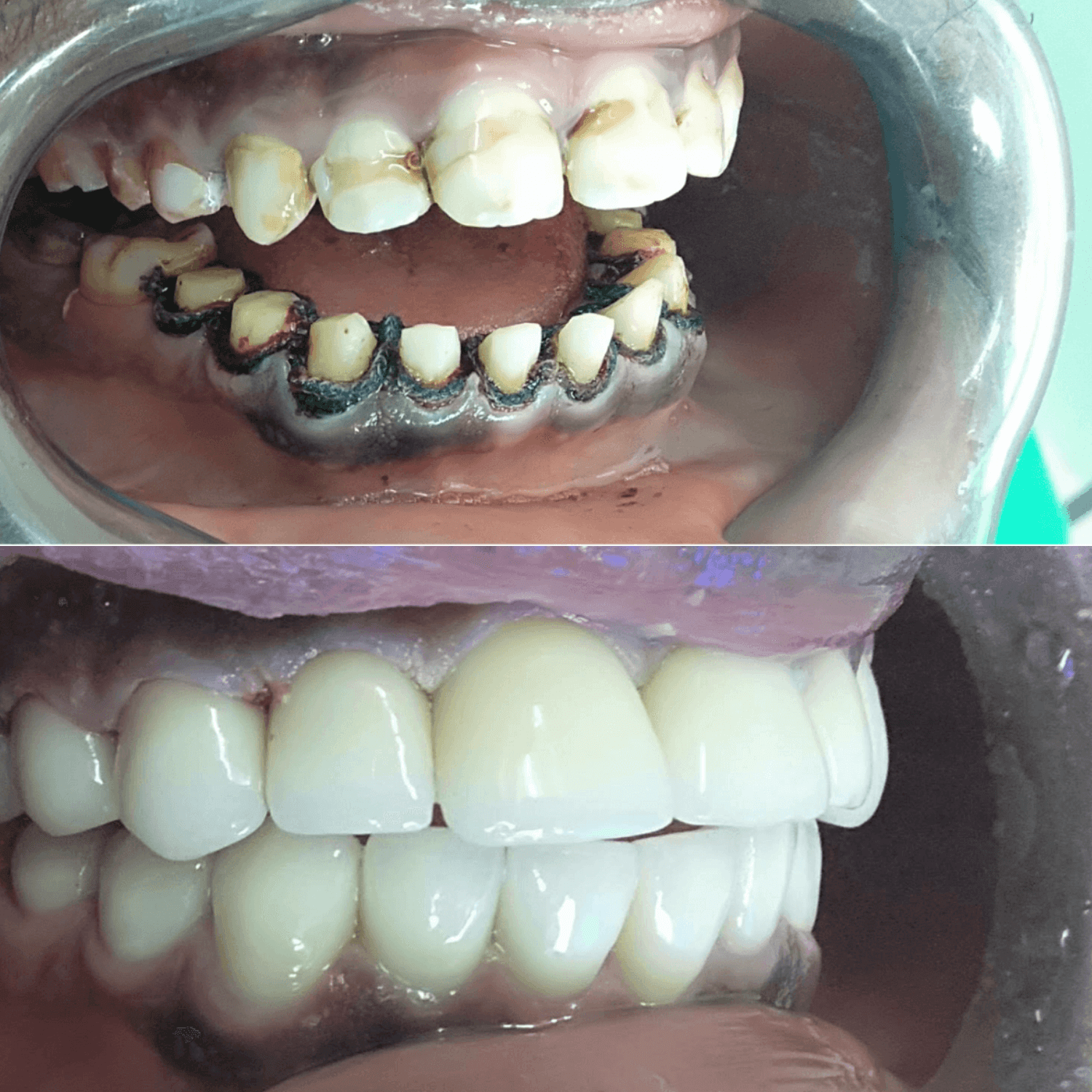 Dentist for Crowns in Kenya: Cost, Types, Procedure, and Best Clinics in Nairobi 2026