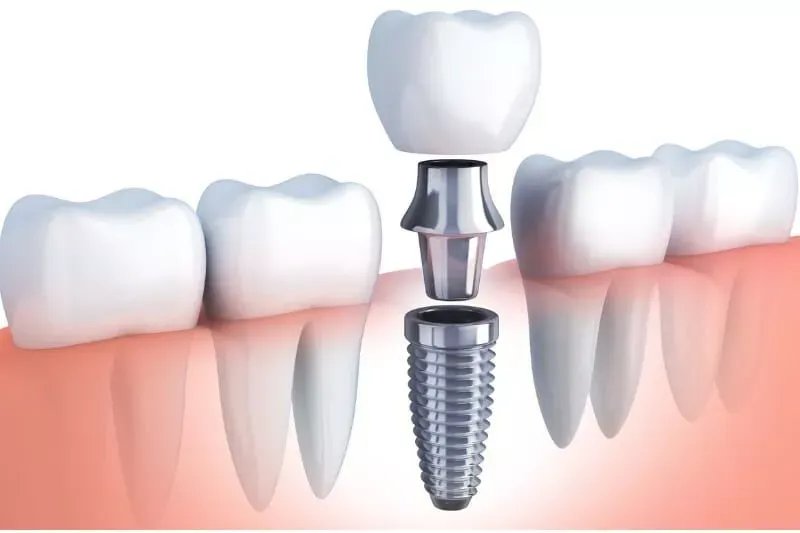Dental Implants in Kenya: Cost, Procedure & Benefits
