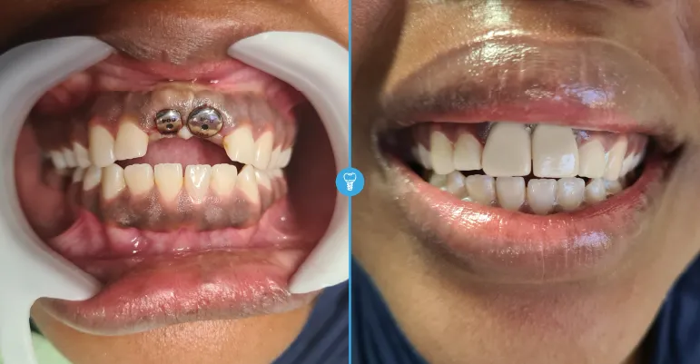 Tooth Replacement Cost in Nairobi 2026