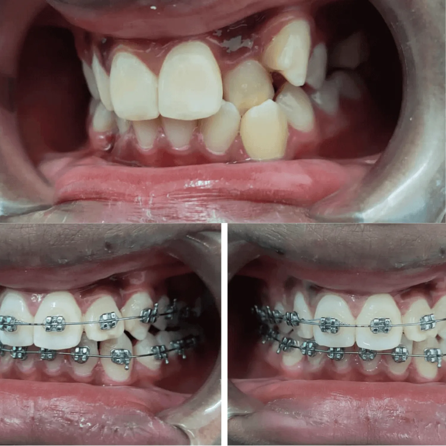 Braces Price in Kenya 2026
