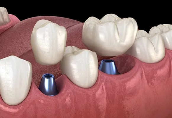 Dental Crown Vs Bridge Cost In Kenya 2026