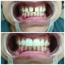 Teeth Cleaning Kenya 2026