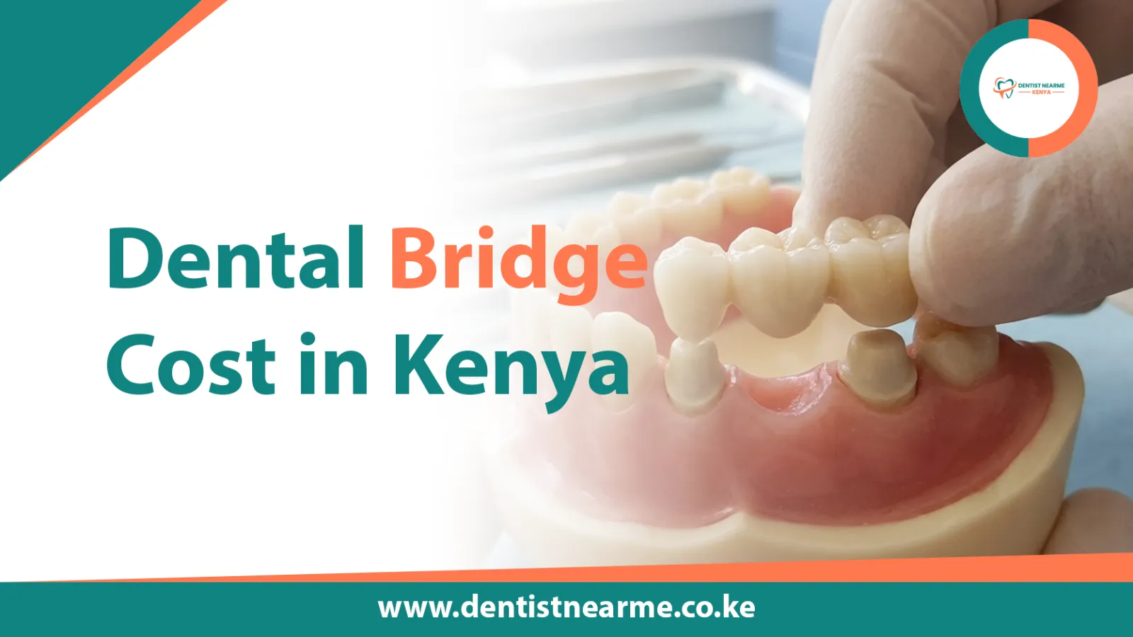 Dental Bridge Cost in Kenya 2026